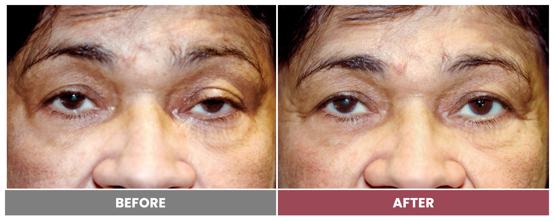 PTOSIS REPAIR - Case 18